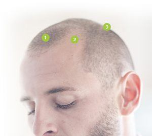 alopecie-masculine-tunisie