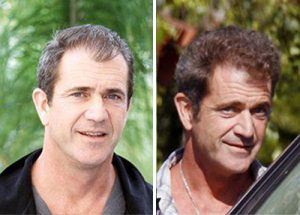 greffe-cheveux-Mel-gibson