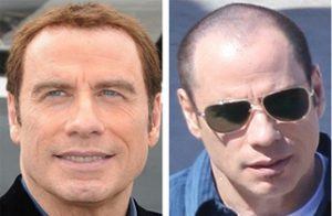 greffe-cheveux-travolta