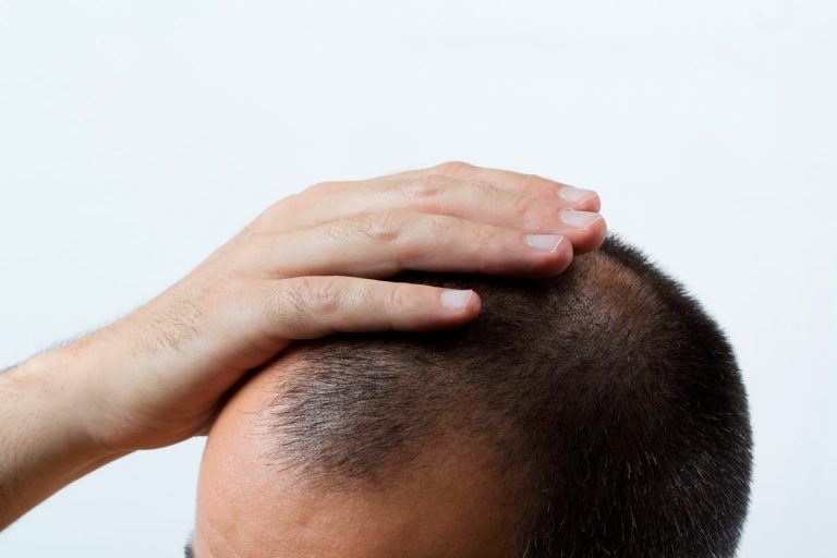 Ce qu’il faut savoir avant d’envisager une greffe de cheveux