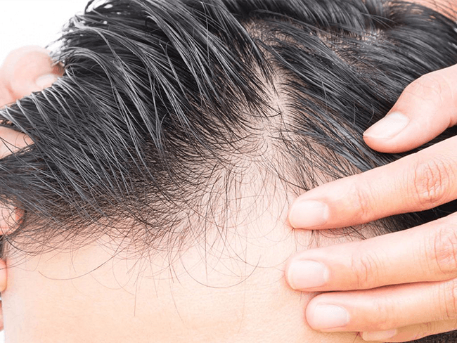 La greffe de cheveux, un solution éprouvée à la chute de cheveux