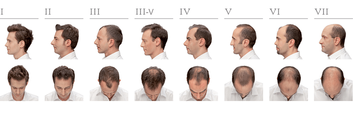 Échelle de Norwood : une mesure du degré de chute de cheveux