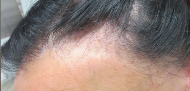 Alopécie cicatricielle : une maladie rare du cuir chevelu