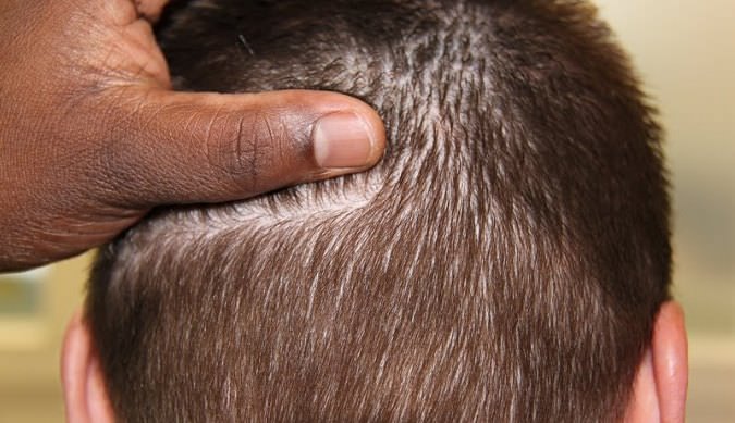 Comment déterminer le nombre optimal de follicules de cheveux à transplanter ?