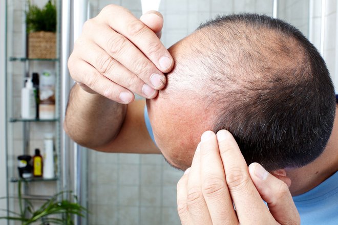 Les raisons qui poussent les patients à réaliser une greffe de cheveux