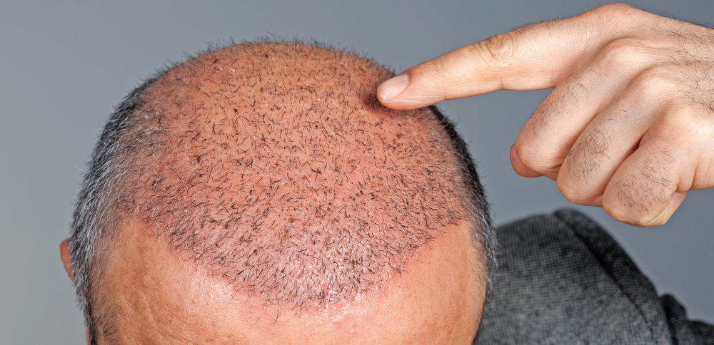 Prendre soin de ses cheveux après la greffe de cheveux FUE