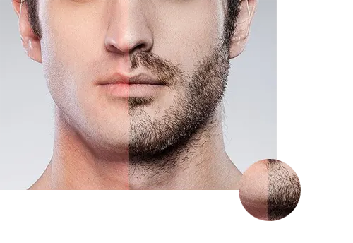 greffe barbe tunisie moustache