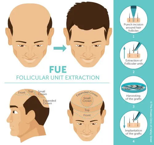 زراعة الشعر FUE تونس