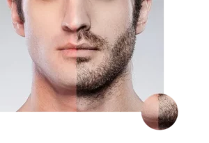 زراعة شعر اللحية تونس