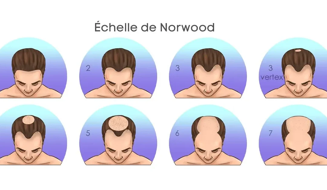 Echelle de Norwood : quelle est son utilité pour une greffe de cheveux ?