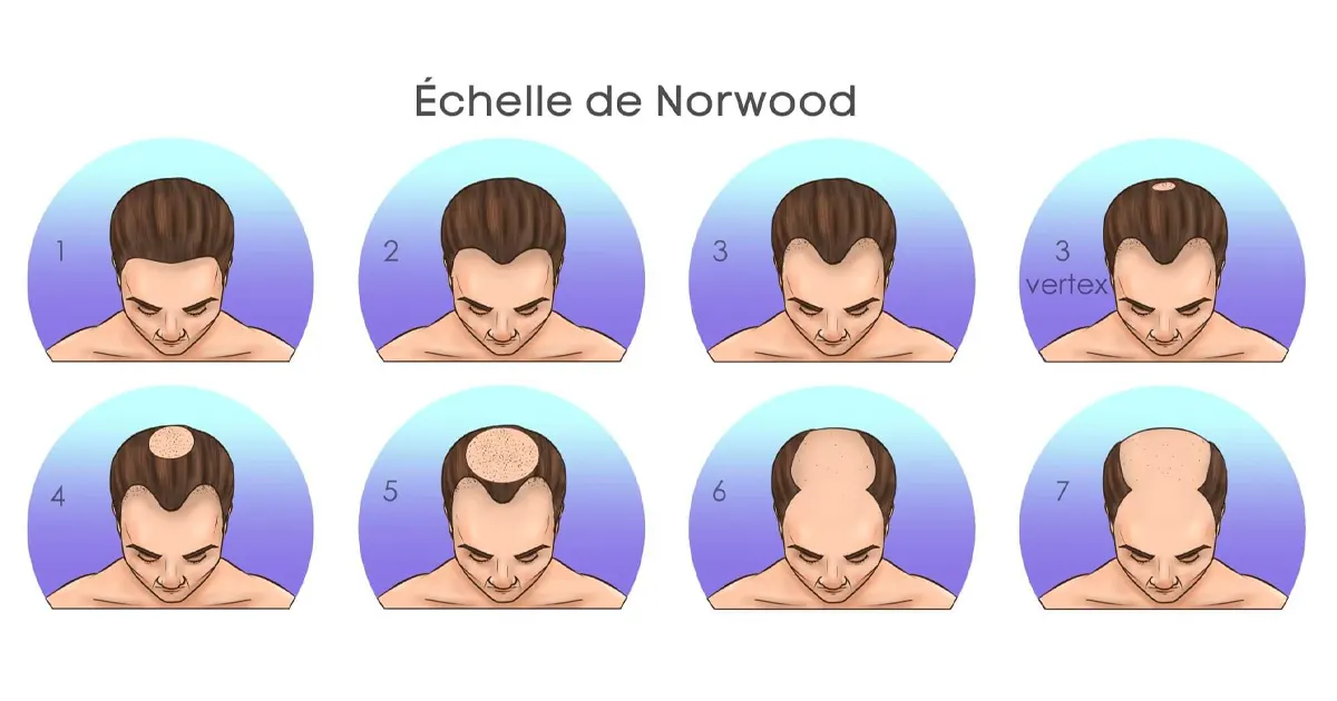 Échelle de Norwood-Hamilton