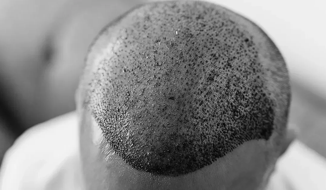 Quel médecin consulter pour traiter la chute de cheveux ?