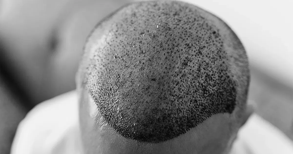 Quel médecin consulter pour traiter la chute de cheveux ?