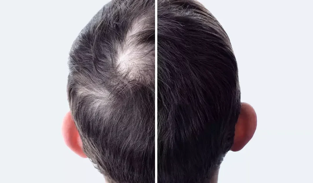 Cheveux, barbe, moustache pourquoi leur densité et leur texture sont-elles nettement différentes