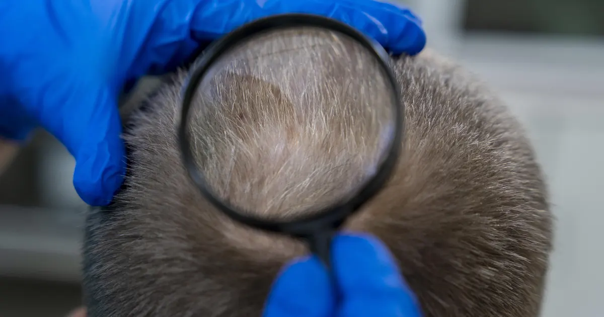 la-clinique-implants-capillaires