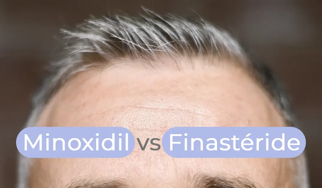 Minoxidil-Finastéride