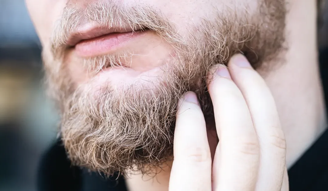 la greffe de barbe et de moustache